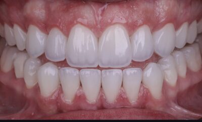 Carillas Dentales Impresas en 3D: La Revolución de la Estética Dental en Granada