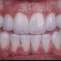 Carillas Dentales Impresas en 3D: La Revolución de la Estética Dental en Granada