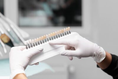 Carillas dentales en Granada: Guía para elegir el material perfecto