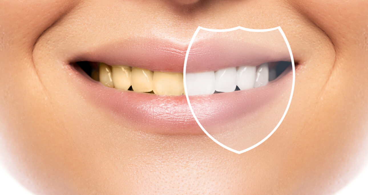¿Por qué se amarillean los dientes y cómo solucionarlo de forma segura?