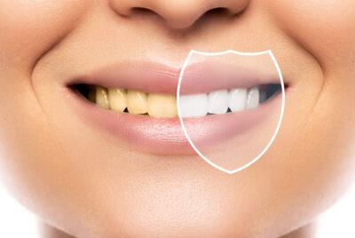 ¿Por qué se amarillean los dientes y cómo solucionarlo de forma segura?