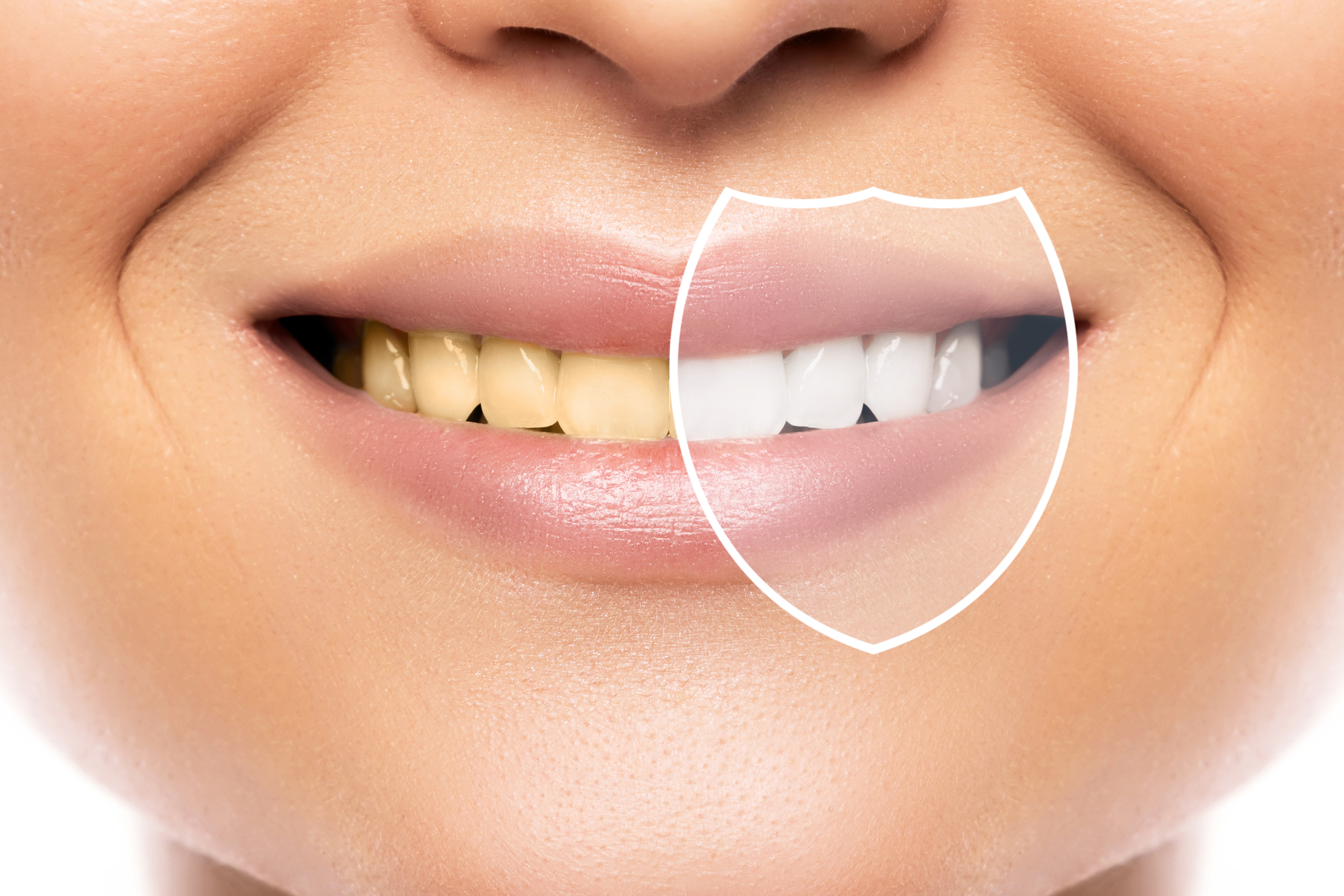 ¿Por qué se amarillean los dientes y cómo solucionarlo de forma segura?