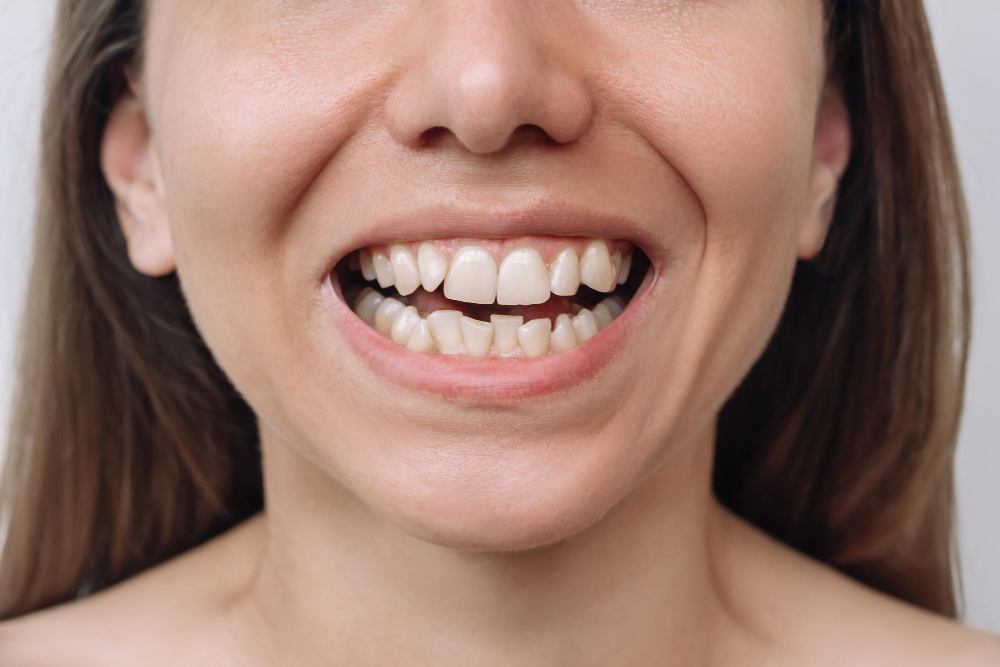 Cómo corregir dientes desalineados sin usar ortodoncia tradicional